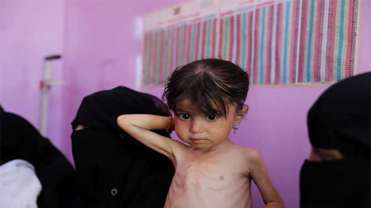 Malnutrition worsening in Yemen's government-controlled areas, UN says