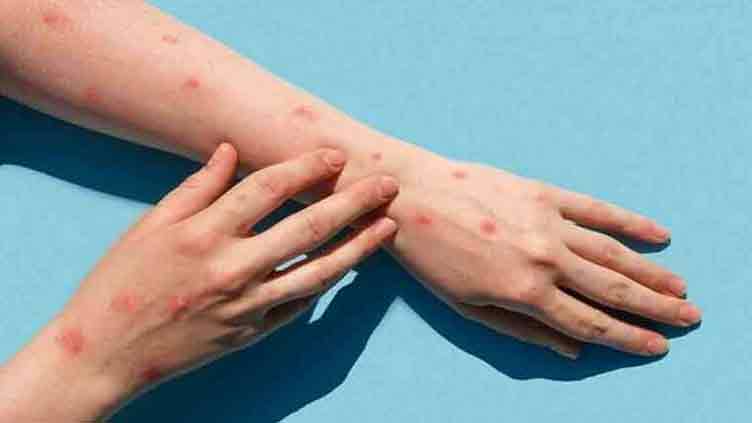 Second monkeypox case confirmed in Pakistan