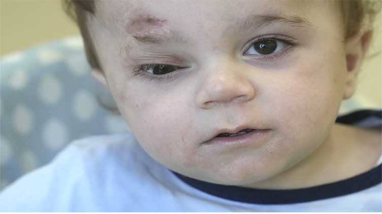 A baby evacuated from Gaza lost an eye and most of his family in the war