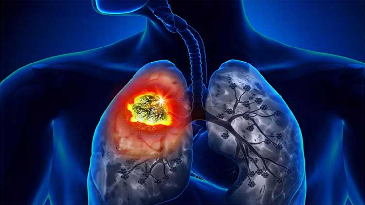 World's first lung cancer vaccine trials launched 