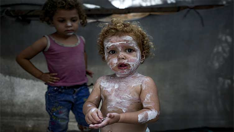 Dunya News Lice, scabies, rashes plague Palestinian children as skin disease runs rampant in Gaza's tent camps