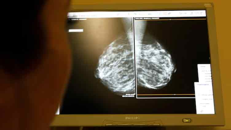 New breast cancer genes found in women of African ancestry may improve risk assessment
