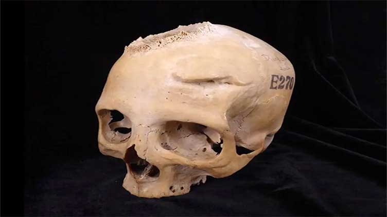 Evidence of cancer treatment found in 4,000-year-old skull
