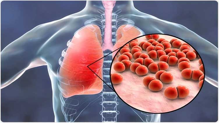 Effects of worsening air quality make pneumonia harder to control