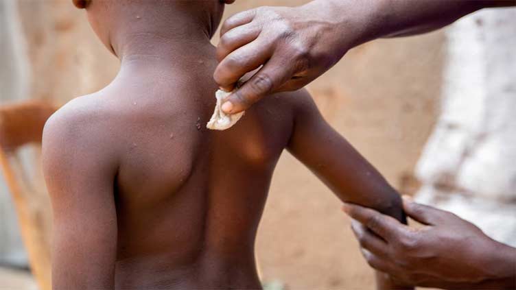 Stigma adds to Burundi's challenges in mpox fight