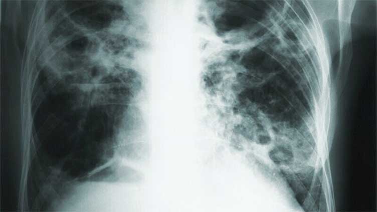 Record high 8.2m TB cases reported in 2023