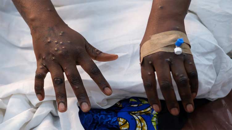 Almost 30,000 suspected mpox cases in Africa this year, WHO says