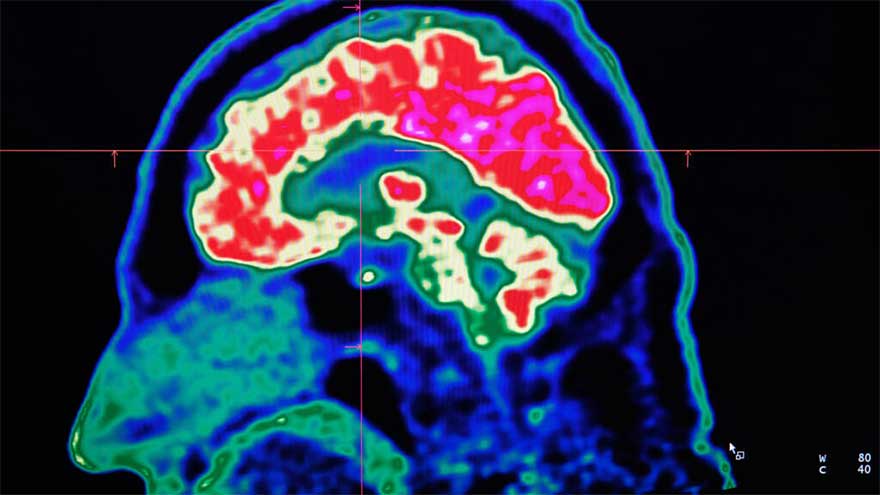 Dunya News What are all these microplastics doing to our brains?