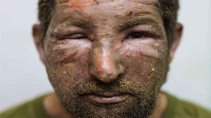 High-tech drones turn Ukraine's front line into a deadly kill zone, complicating evacuations