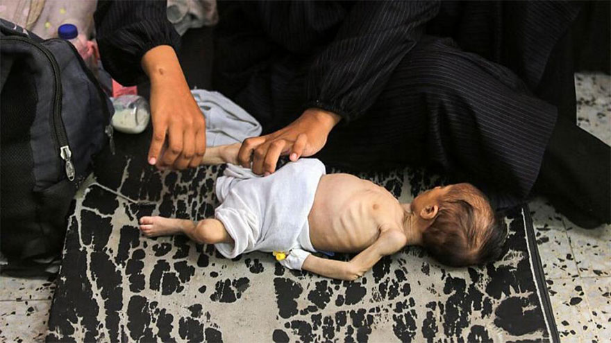 Malnourished Gaza children facing death without aid, says UN