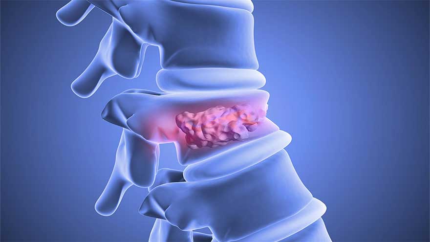 Fat stem cells heal broken spines in a breakthrough study