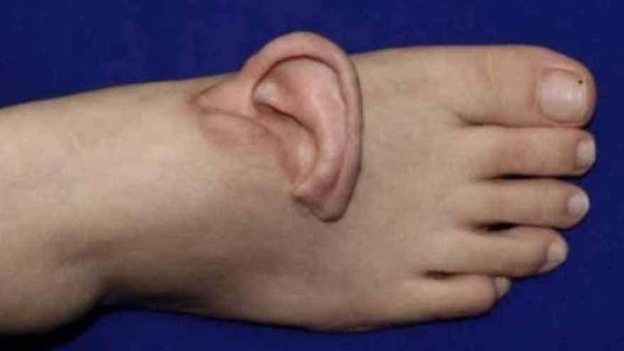 Chinese surgeons save severed ear by temporarily attaching it to patient's foot