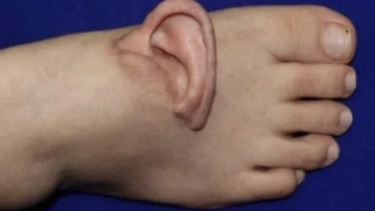 ڈاکٹروں نے انوکھی سرجری کر کے خاتون کا کان پاؤں پر لگا دیا