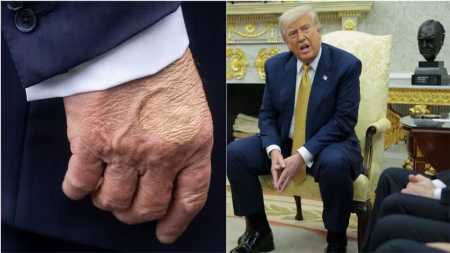 Trump diagnosed with vein issue after leg swelling, hand bruising