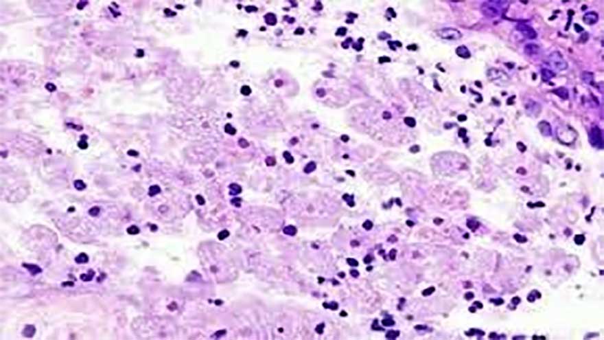 Sindh reports fourth death from brain-eating amoeba this year