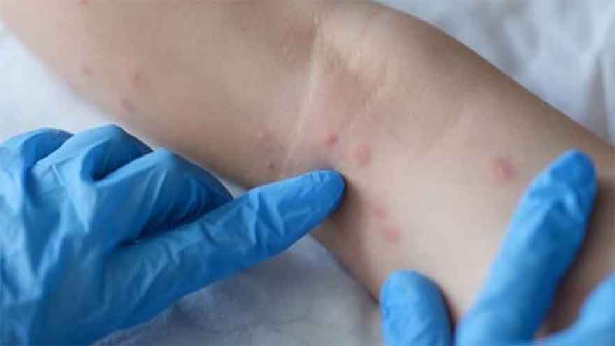 Passenger arriving from Saudi Arabia shows monkeypox symptoms