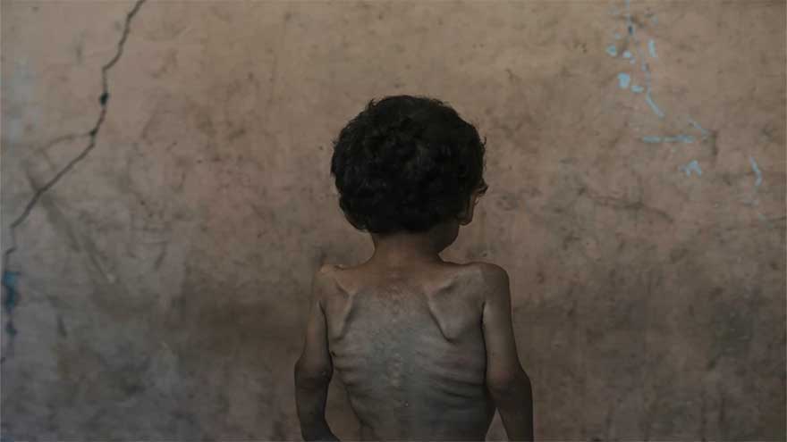 Dunya News More than 54,600 children younger than 5 may be acutely malnourished in Gaza, study finds