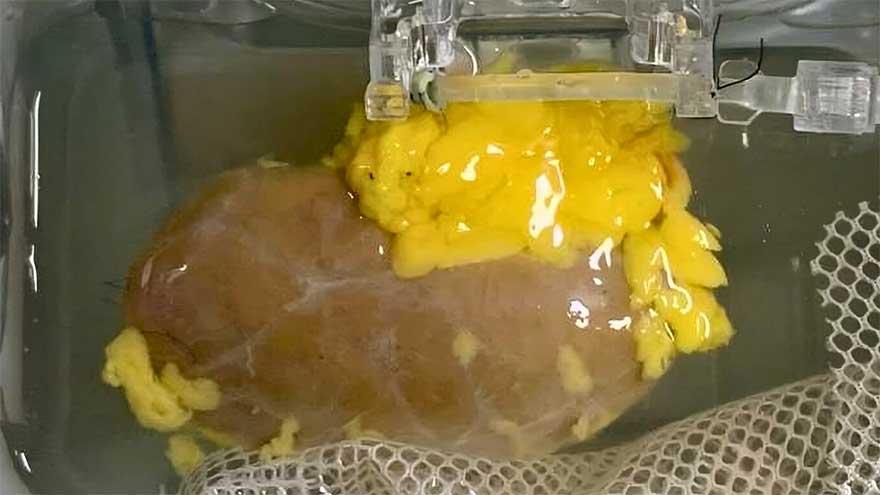 Scientists create 'universal' kidney to match any blood type