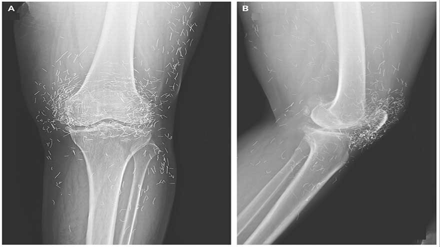Woman's severe knee pain reveals 'golden threads' in her joints