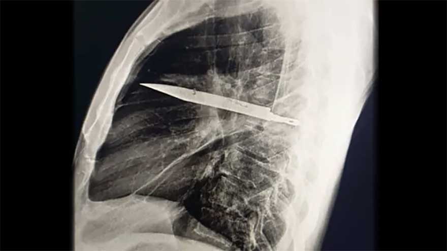 A knife broke off in a man's chest, and he didn't notice it for 8 years