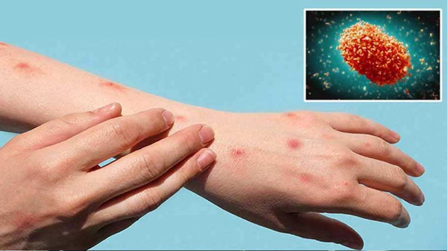 Monkeypox cases confirmed among children in Khairpur