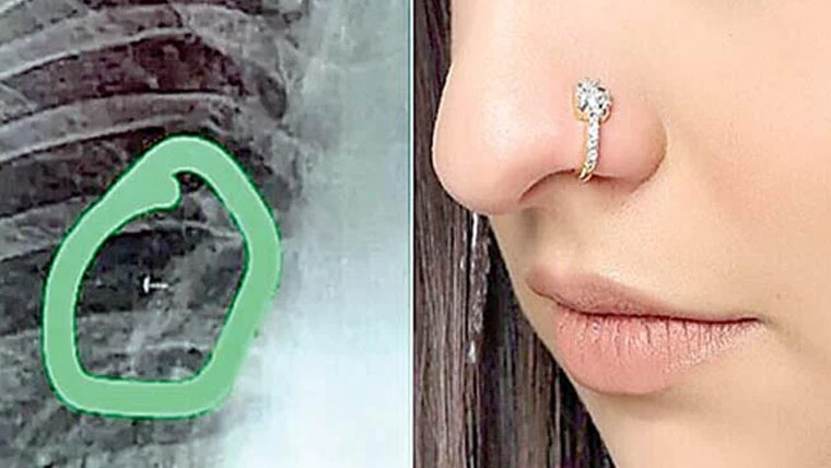 ناک کی بالی پھیپھڑے میں پھنس گئی، خاتون معجزانہ طور پر بچ گئی