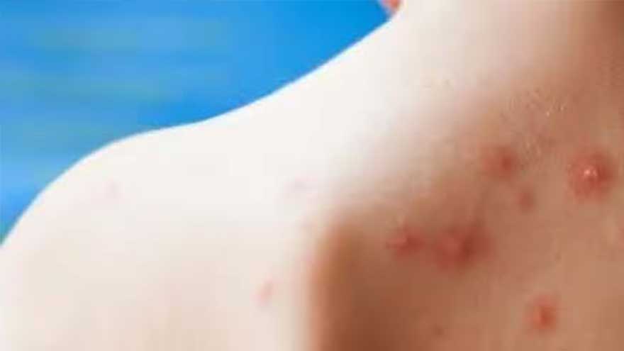 Measles claims 71 lives across Pakistan as over 16,000 suspected cases reported