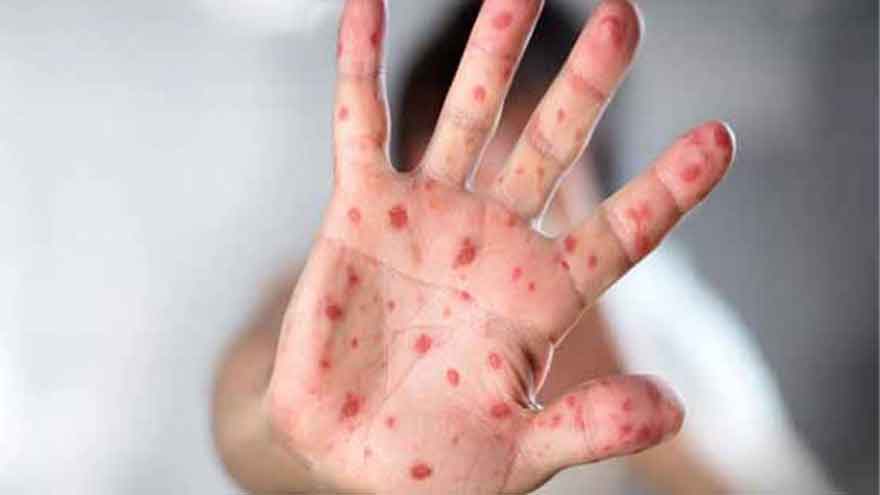Two children die of measles in Lower South Waziristan