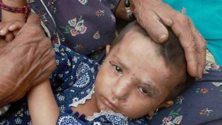 خیر پور نارا میں خسرہ بے قابو، تین بچوں کی جانیں نگل گیا