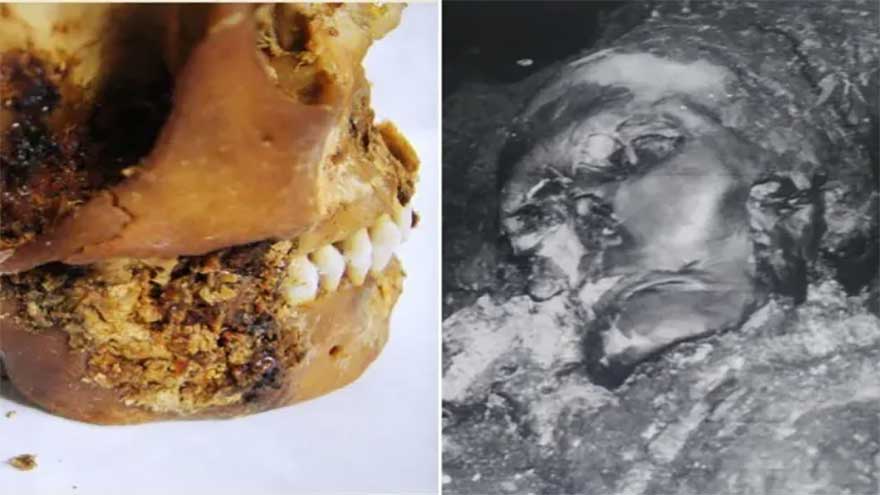 Mummified skull reveals woman had life-saving surgery 2,500 years ago