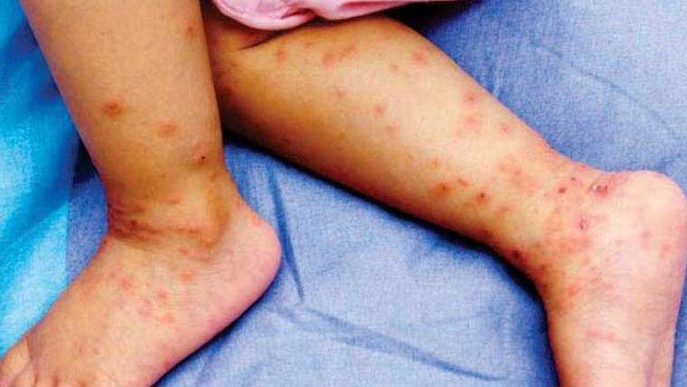 قصور میں خسرہ کی وبا پھوٹ پڑی، ایک ہی گاؤں کے 8 بچے متاثر