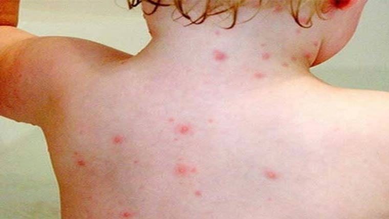 کبیروالا میں خسرہ سے7 بچے انتقال کر گئے