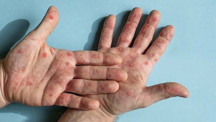 کراچی میں منکی پاکس کا مشتبہ کیس سامنے آگیا