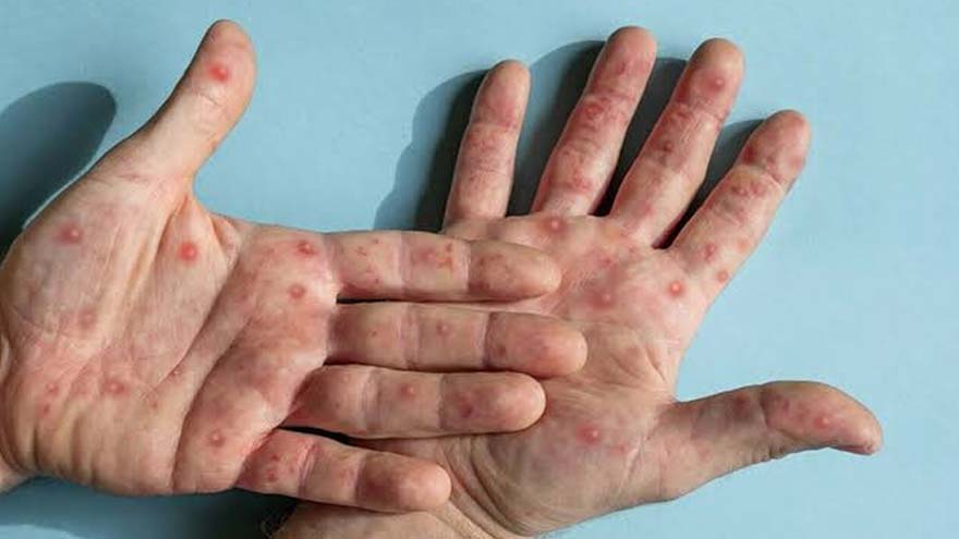 50-year-old Nawabshah resident tests positive for mpox