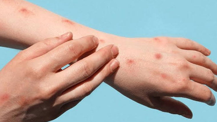 سندھ میں منکی پاکس کا ایک اور کیس رپورٹ، تعداد 100 سے متجاوز