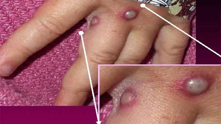 کراچی میں ایم پاکس کے مزید 3 تصدیق شدہ کیسز، رواں سال تعداد 13 ہوگئی